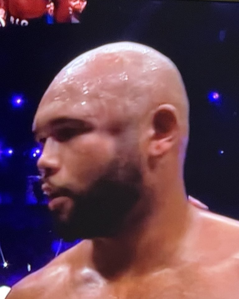 You are currently viewing ‘Never seen anything like it’ – Frazer Clarke left with huge dent in side of his head after Fabio Wardley’s stunning first round KO