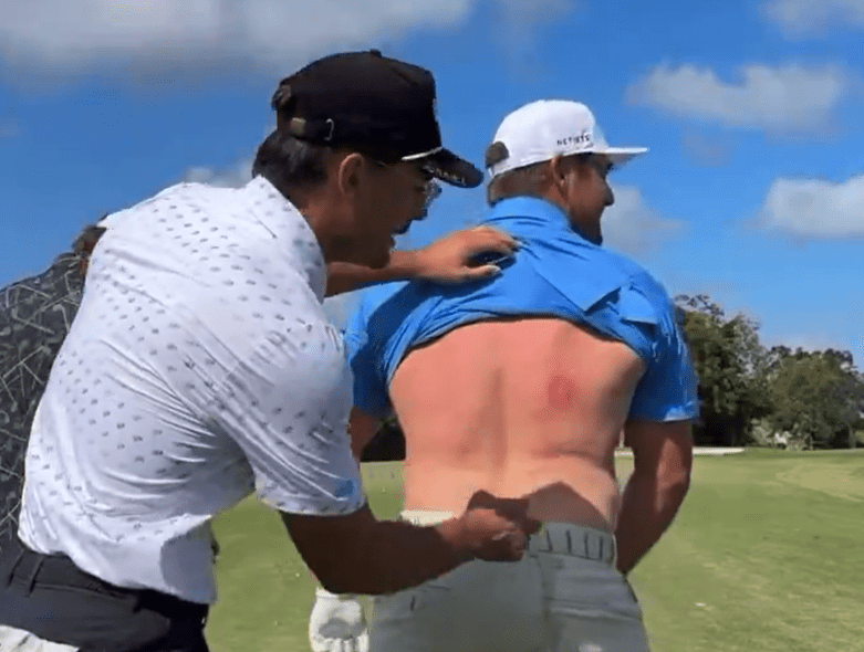 You are currently viewing Bryson DeChambeau left with gruesome bruise after being hit with rock hard egg