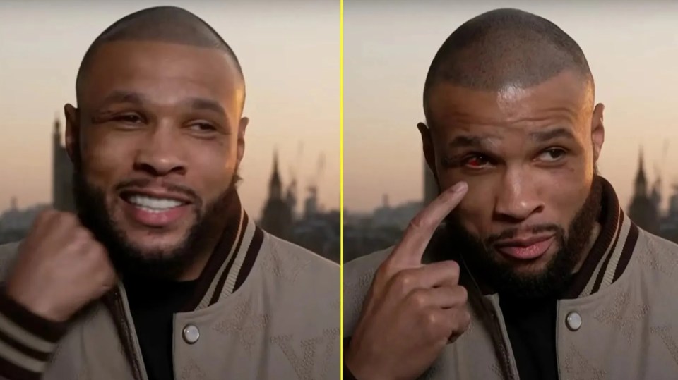 You are currently viewing Chris Eubank Jr gives first injury update after Conor Benn fight: ‘I had surgery’